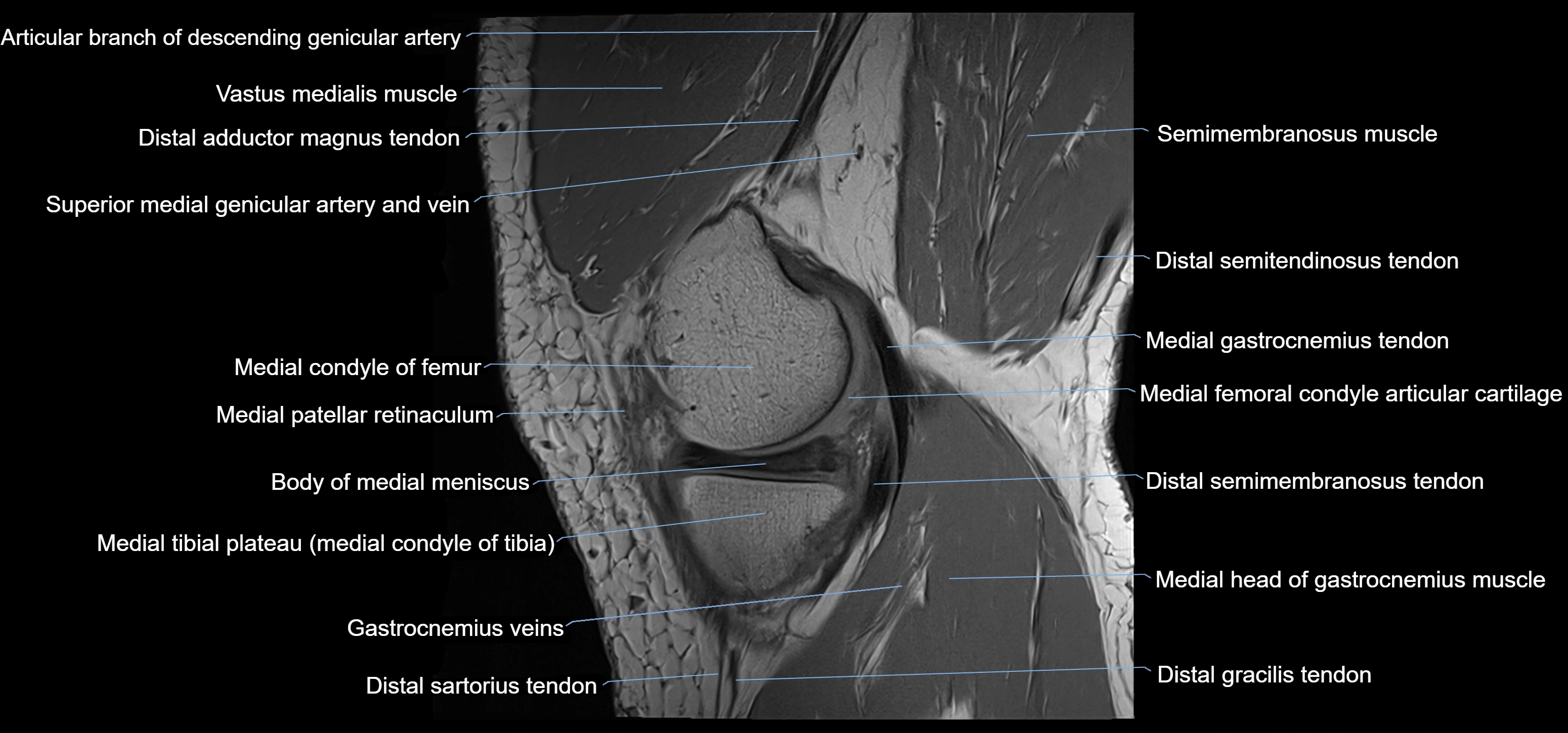 MRI knee sagittal cross sectional anatomy labelled 3T radiology image-00012.webp